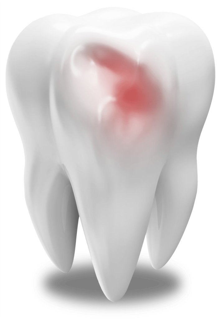 damaged tooth model The Oral Surgery Group