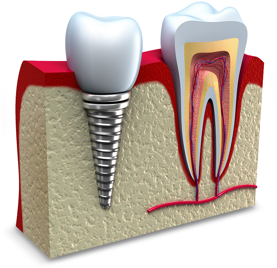 failing dental implant model The Oral Surgery Group