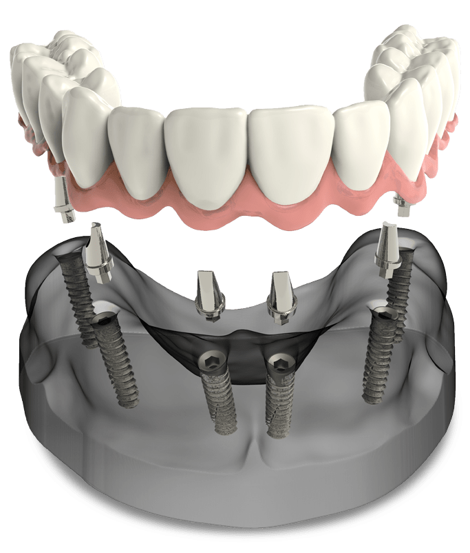 full arch dental implants model The Oral Surgery Group